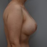 Breast Augmentation Before & After Patient #3432