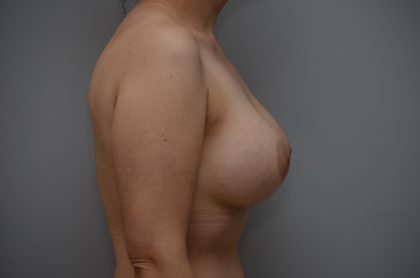 Breast Augmentation Before & After Patient #3432