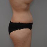Abdominoplasty Before & After Patient #3443