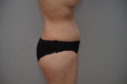 Abdominoplasty Before & After Patient #3443