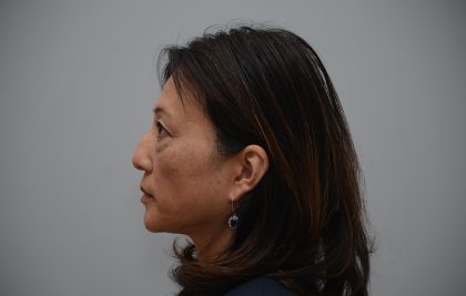 Blepharoplasty Before & After Patient #3421