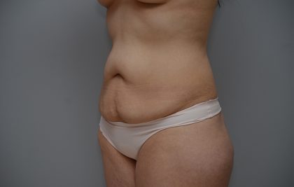Abdominoplasty Before & After Patient #3443