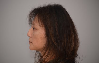 Blepharoplasty Before & After Patient #3421