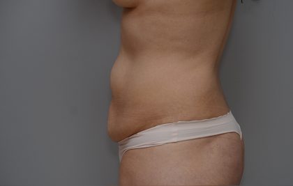 Abdominoplasty Before & After Patient #3443