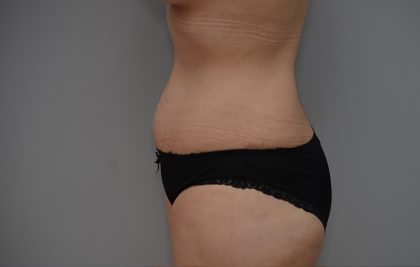 Abdominoplasty Before & After Patient #3443