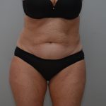 Abdominoplasty Before & After Patient #3933