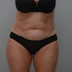 Abdominoplasty Before & After Patient #3933