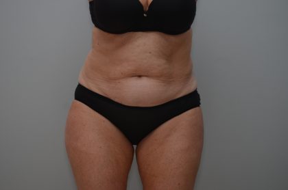 Abdominoplasty Before & After Patient #3933