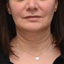 Mini Facelift Before & After Patient #3942