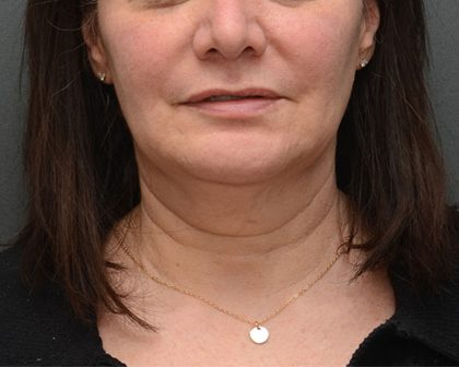 Mini Facelift Before & After Patient #3942