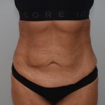Abdominoplasty Before & After Patient #3932