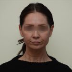 Facelift Before & After Patient #3934