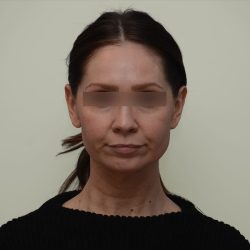 Facelift Before & After Patient #3934