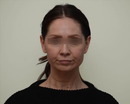 Facelift Before & After Patient #3934