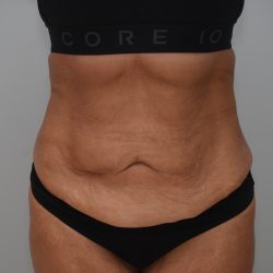 Abdominoplasty Before & After Patient #3932