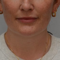 Neck Liposuction Before & After Patient #3935
