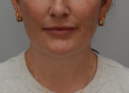 Neck Liposuction Before & After Patient #3935