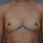 Breast Augmentation Before & After Patient #3936