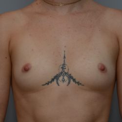 Breast Augmentation Before & After Patient #3936