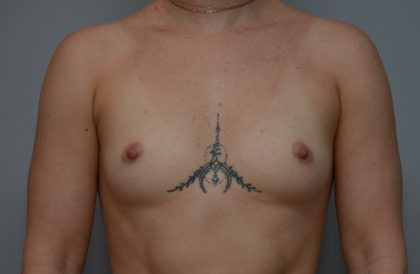 Breast Augmentation Before & After Patient #3936