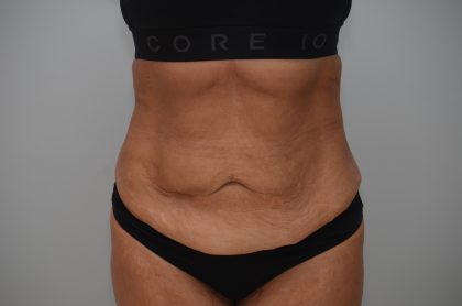 Abdominoplasty Before & After Patient #3932