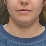 Facetite Before & After Patient #3937