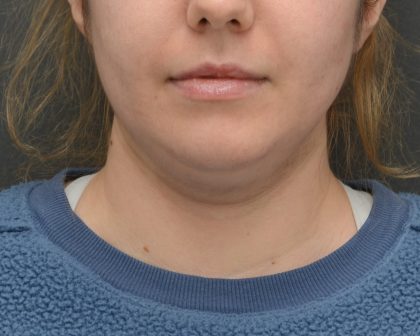 Facetite Before & After Patient #3937
