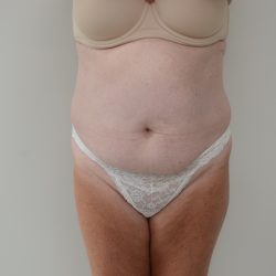 Abdominoplasty Before & After Patient #3938