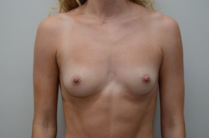 Breast Augmentation Before & After Patient #3939