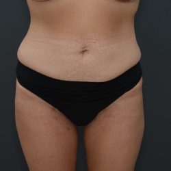 Abdominoplasty Before & After Patient #3941
