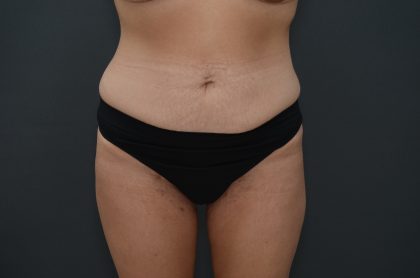 Abdominoplasty Before & After Patient #3941