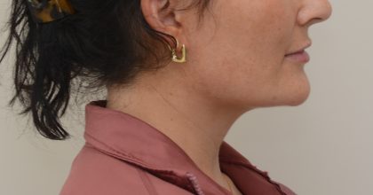 Neck Liposuction Before & After Patient #3935
