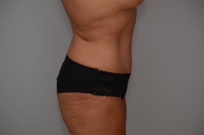 Abdominoplasty Before & After Patient #3932