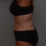 Abdominoplasty Before & After Patient #3933