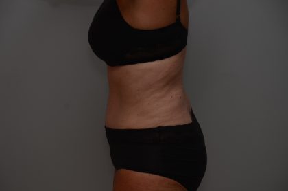 Abdominoplasty Before & After Patient #3933