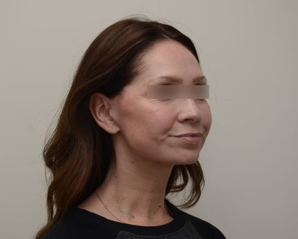 Facelift Before & After Patient #3934