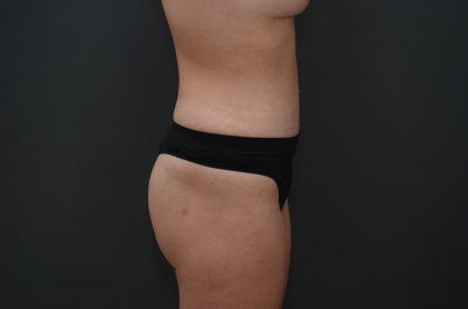 Abdominoplasty Before & After Patient #3941