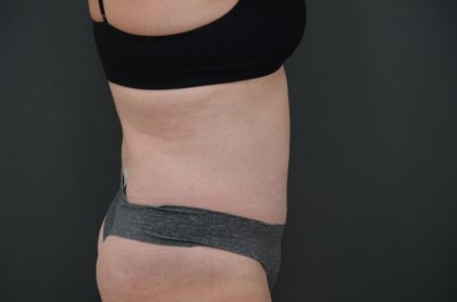 Abdominoplasty Before & After Patient #3938