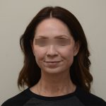 Facelift Before & After Patient #3934