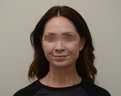 Facelift Before & After Patient #3934