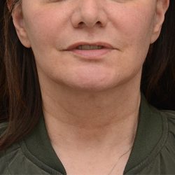 Mini Facelift Before & After Patient #3942