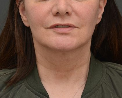 Mini Facelift Before & After Patient #3942