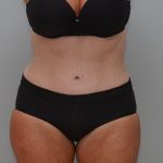 Abdominoplasty Before & After Patient #3933