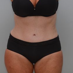 Abdominoplasty Before & After Patient #3933