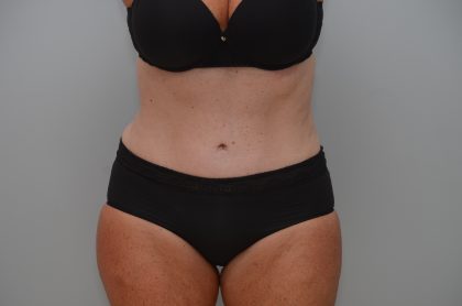 Abdominoplasty Before & After Patient #3933