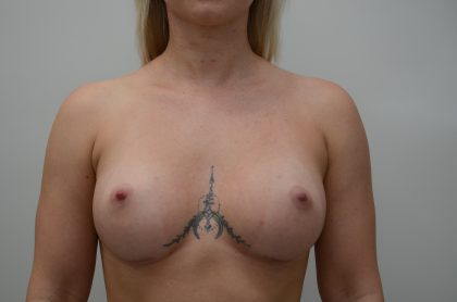 Breast Augmentation Before & After Patient #3936