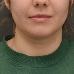 Facetite Before & After Patient #3937