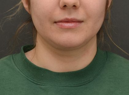 Facetite Before & After Patient #3937