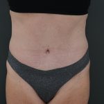 Abdominoplasty Before & After Patient #3938