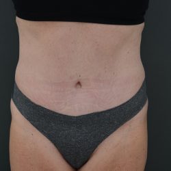 Abdominoplasty Before & After Patient #3938